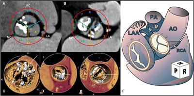 Effect of Eccentric Calcification of an Aortic Valve on the Implant Depth of a Venus-A Prosthesis During Transcatheter Aortic Valve Replacement: A Retrospective Study